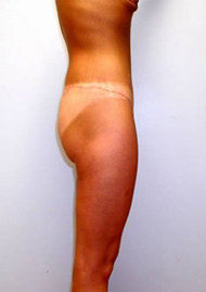 Thigh Lift Before & After Image