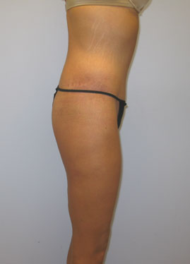 Thigh Lift Before & After Image