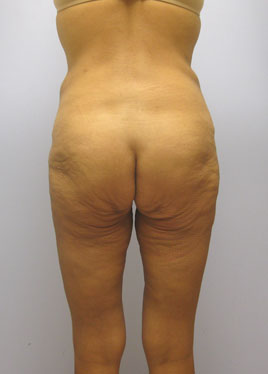 Thigh Lift Before & After Image