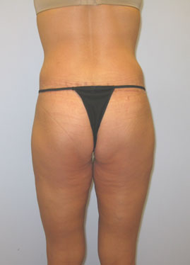 Thigh Lift Before & After Image