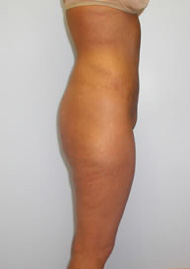 Thigh Lift Before & After Image