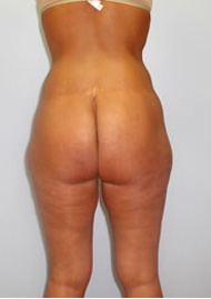 Thigh Lift Before & After Image