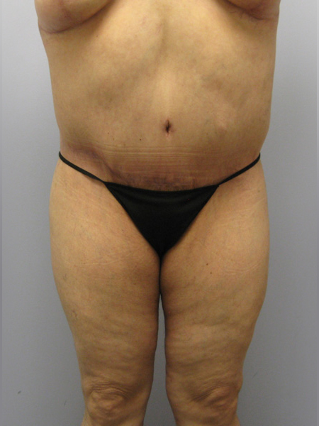 Thigh Lift Before & After Image