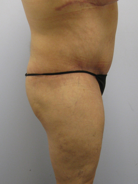 Thigh Lift Before & After Image