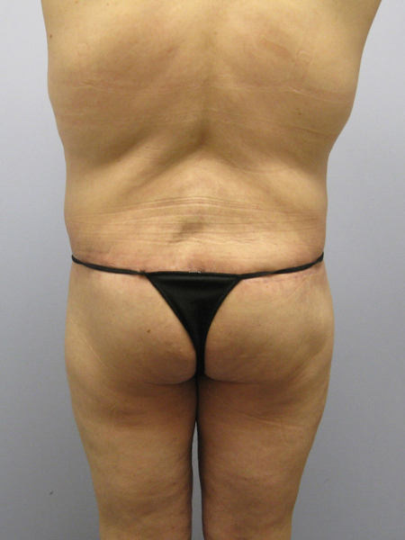 Thigh Lift Before & After Image