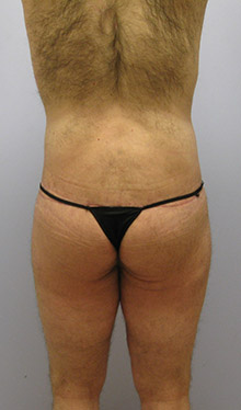 Thigh Lift Before & After Image