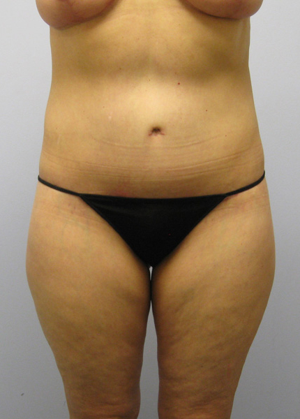 Thigh Lift Before & After Image