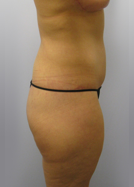 Thigh Lift Before & After Image