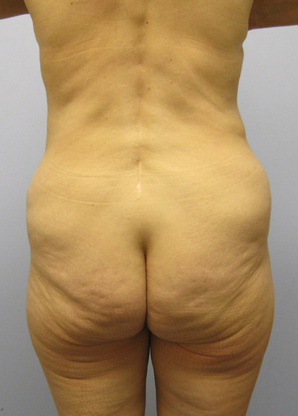 Thigh Lift Before & After Image