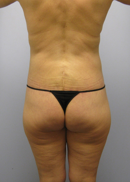 Thigh Lift Before & After Image