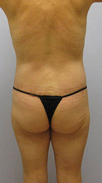 Thigh Lift Before & After Image