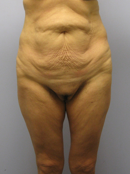 Thigh Lift Before & After Image