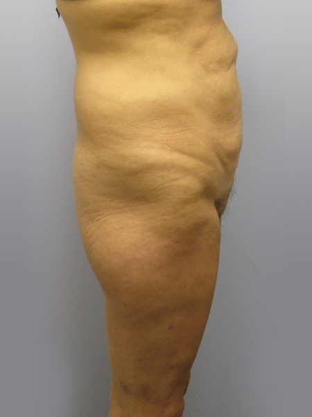 Thigh Lift Before & After Image