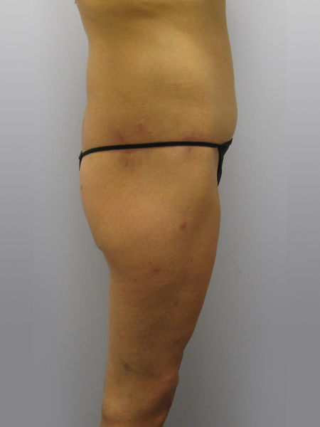 Thigh Lift Before & After Image