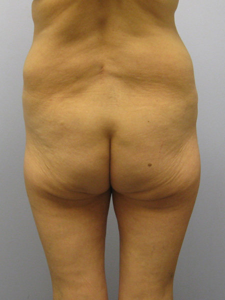 Thigh Lift Before & After Image