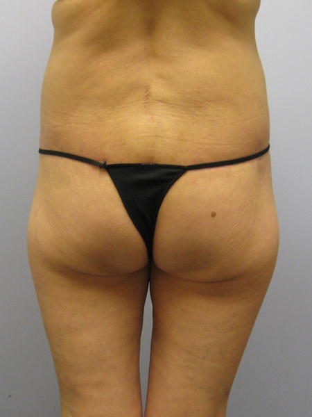 Thigh Lift Before & After Image