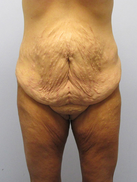 Thigh Lift Before & After Image