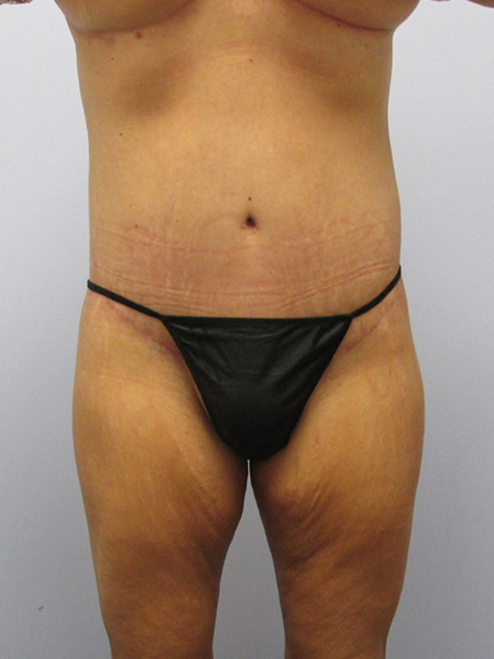 Thigh Lift Before & After Image