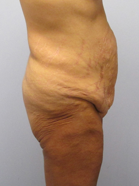 Thigh Lift Before & After Image