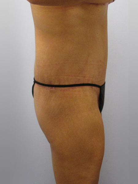 Thigh Lift Before & After Image