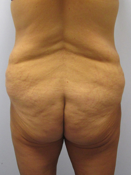 Thigh Lift Before & After Image