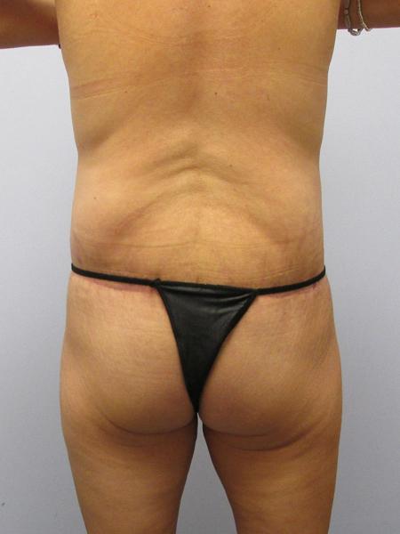 Thigh Lift Before & After Image