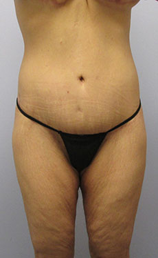 Thigh Lift Before & After Image