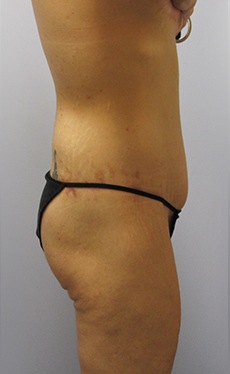 Thigh Lift Before & After Image