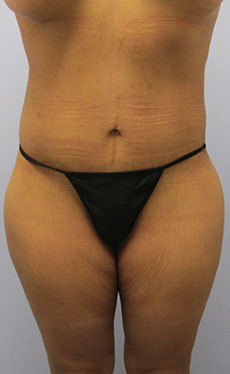 Thigh Lift Before & After Image