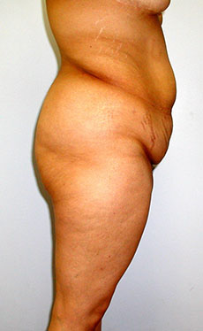 Thigh Lift Before & After Image