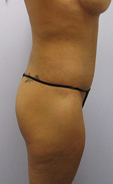 Thigh Lift Before & After Image