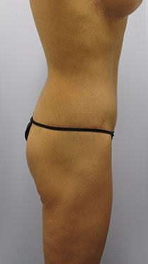 Thigh Lift Before & After Image