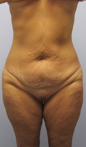 Thigh Lift Before & After Image