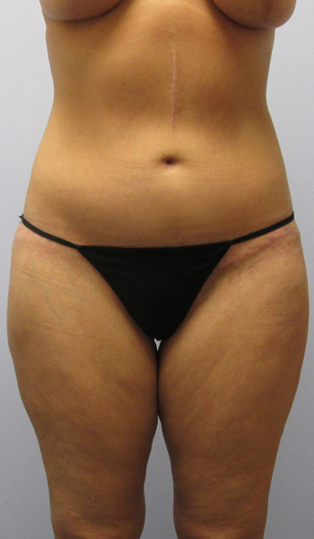 Thigh Lift Before & After Image