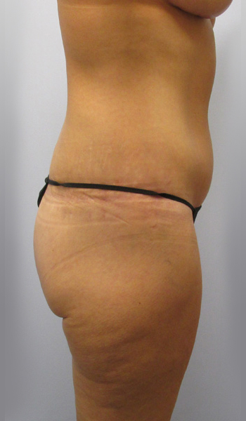 Thigh Lift Before & After Image