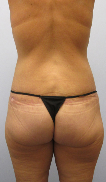 Thigh Lift Before & After Image