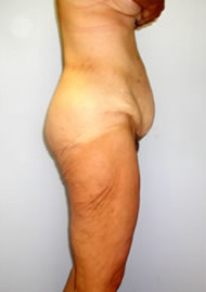 Thigh Lift Before & After Image