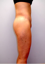 Thigh Lift Before & After Image