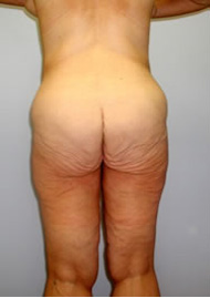 Thigh Lift Before & After Image