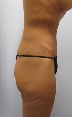 Thigh Lift Before & After Image