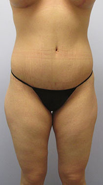 Thigh Lift Before & After Image