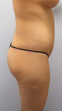 Thigh Lift Before & After Image