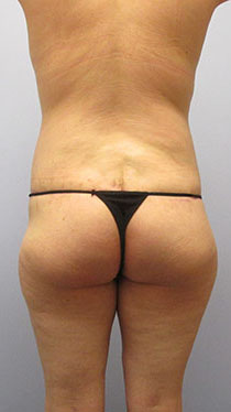 Thigh Lift Before & After Image