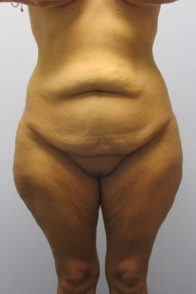 Thigh Lift Before & After Image