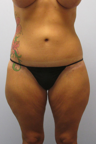 Thigh Lift Before & After Image