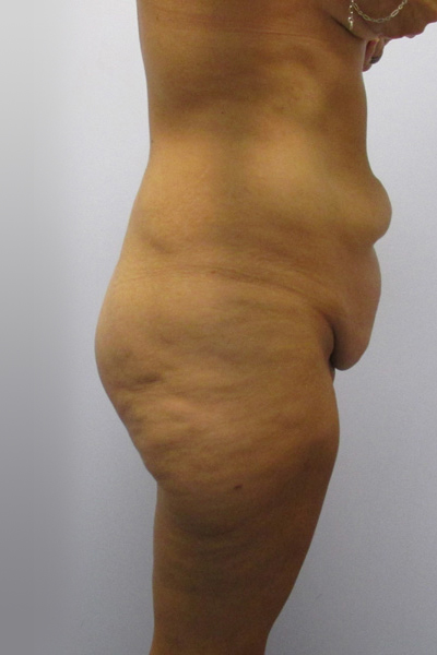 Thigh Lift Before & After Image