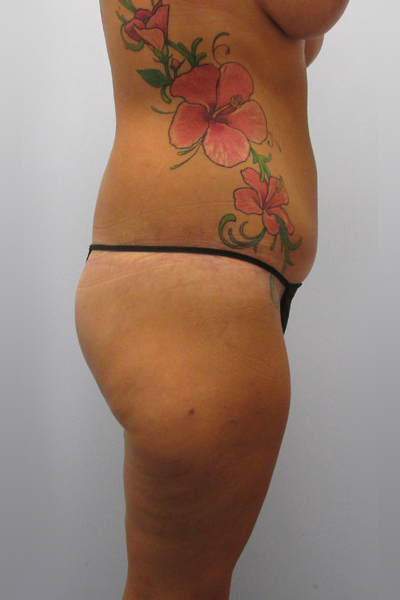 Thigh Lift Before & After Image