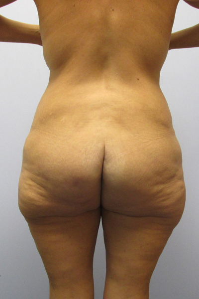 Thigh Lift Before & After Image