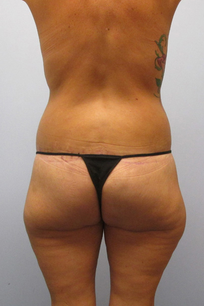 Thigh Lift Before & After Image