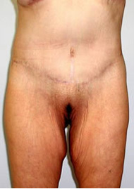 Thigh Lift Before & After Image